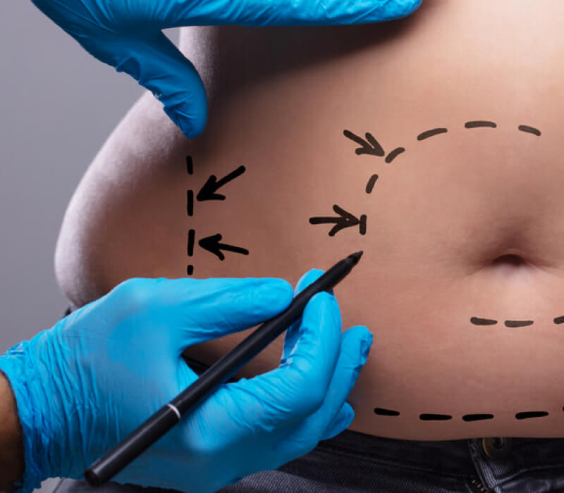 Abdominoplastia