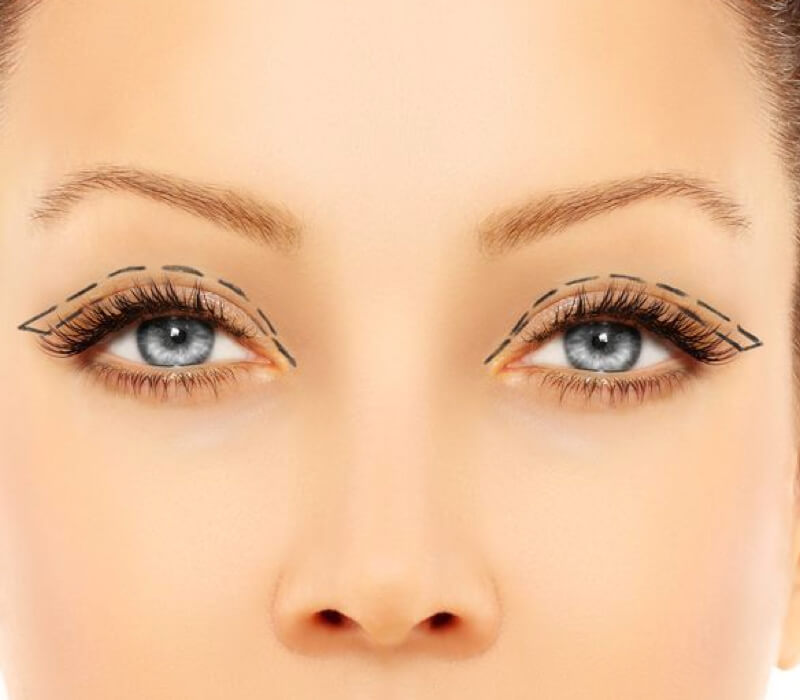 Blefaroplastia